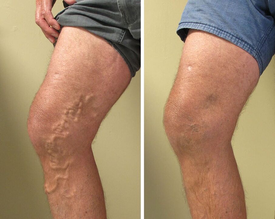 Experience of the use of gel zxcvbnmqwert