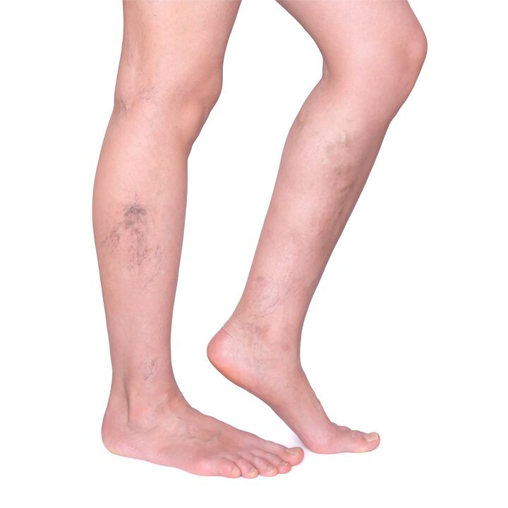 Indications for the primification of Vasaxal - Nabushhiy, convincing veins in the legs