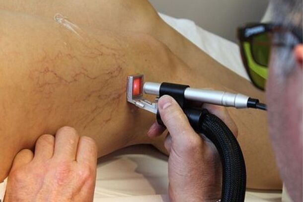Laser treatment of varicose veins of the lower extremities.
