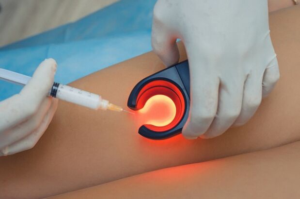 Treatment of varicose veins using sclerotherapy.