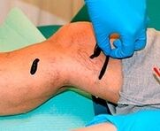 Sanguijuelas for varicose veins