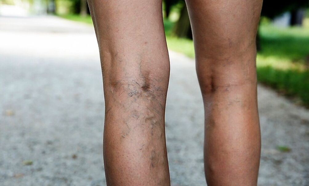 Expanded veins on the legs