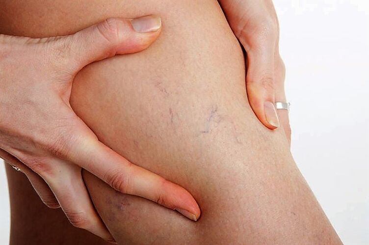 Varicose grid in the leg