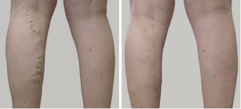 Before and after treatment