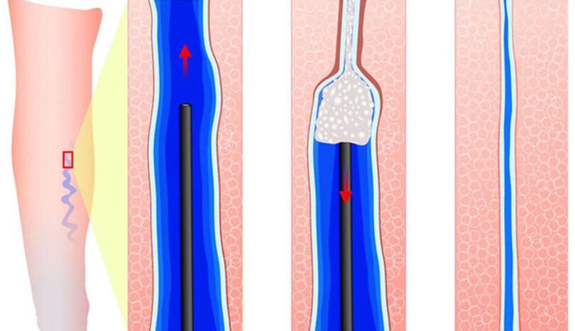 INTRODUCTION OF SCLEROSANTES IN ESCLEROSTIAPIA