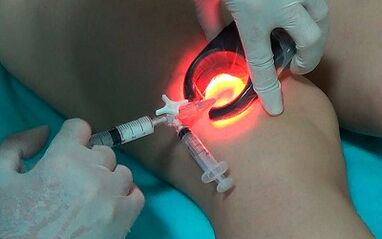 Sclerotherapy as a way of treating varicose veins in the legs