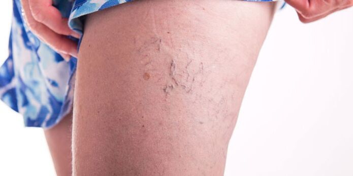 Ways to treat varicose veins