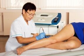 What are varicose veins