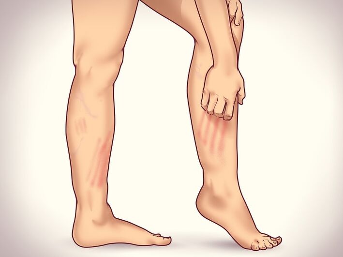 6 signs not obvious of varicose veins