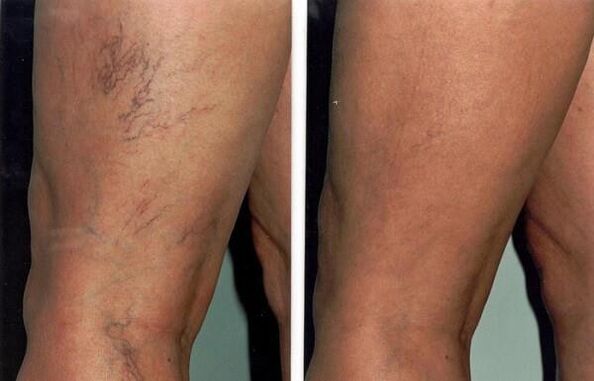 Photos before and after varicose vein treatment.
